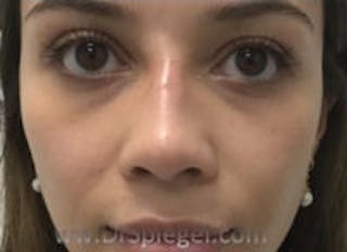 Non-Surgical Rhinoplasty / Nose Filler Before & After Gallery - Patient 157140945 - Image 2