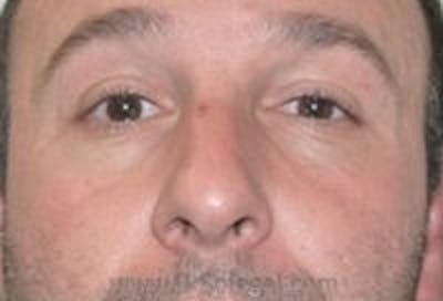 Tear Trough / Under Eye Fillers Before & After Gallery - Patient 157140944 - Image 1