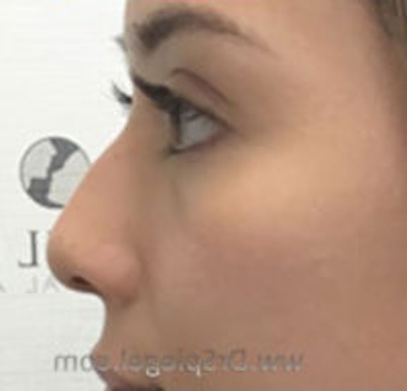 Non-Surgical Rhinoplasty / Nose Filler Before & After Gallery - Patient 157140945 - Image 3