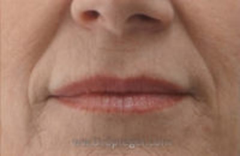 Lip Filler Before & After Gallery - Patient 157140948 - Image 2