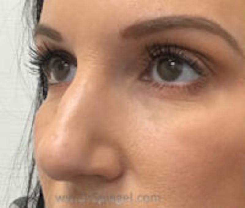 Non-Surgical Rhinoplasty / Nose Filler Before & After Gallery - Patient 157140950 - Image 1