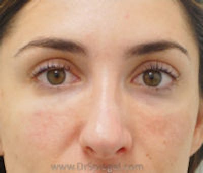Tear Trough / Under Eye Fillers Before & After Gallery - Patient 157140949 - Image 2