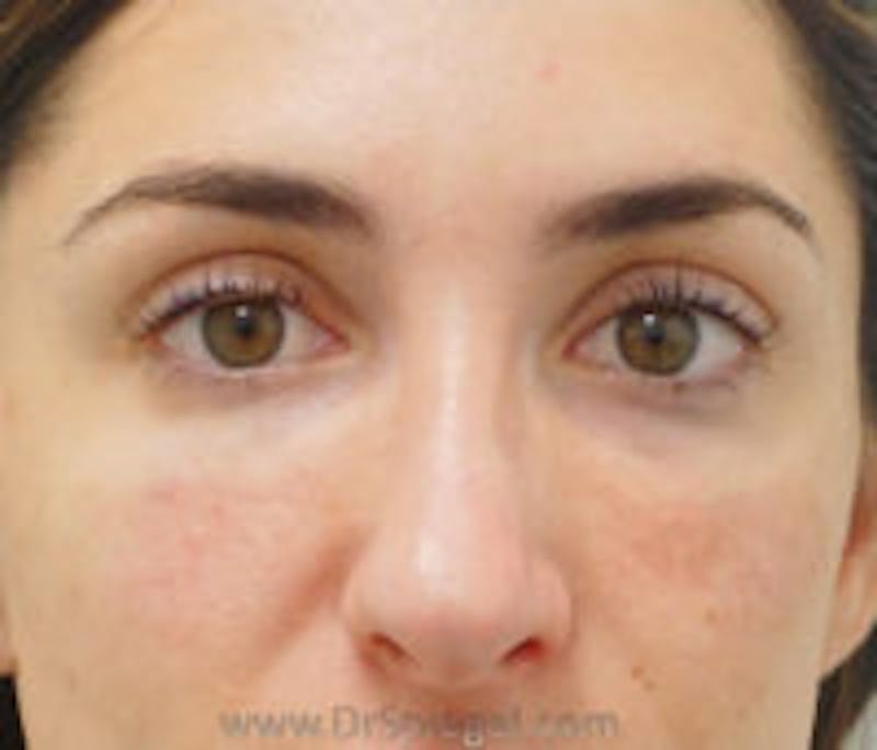 Tear Trough / Under Eye Fillers Before & After Gallery - Patient 157140949 - Image 2