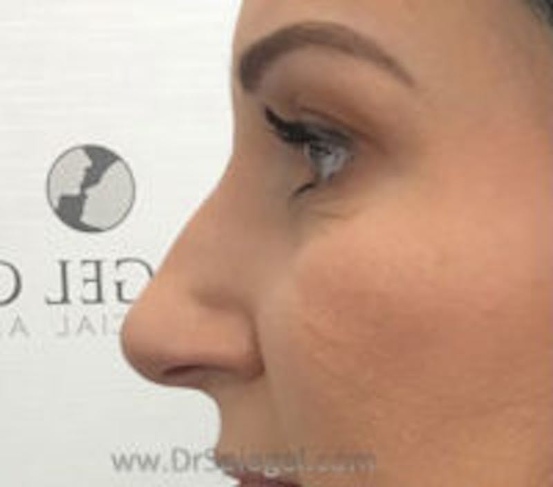 Non-Surgical Rhinoplasty / Nose Filler Before & After Gallery - Patient 157140950 - Image 3