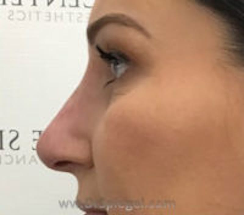 Non-Surgical Rhinoplasty / Nose Filler Before & After Gallery - Patient 157140950 - Image 4