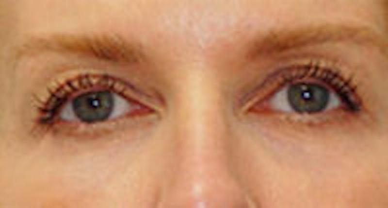 Tear Trough / Under Eye Fillers Before & After Gallery - Patient 157140951 - Image 1