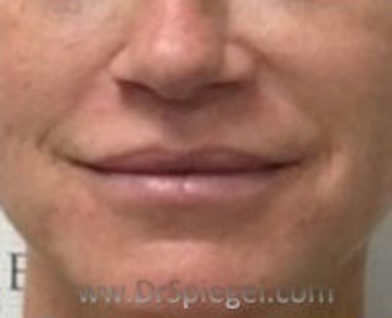 Lip Filler Before & After Gallery - Patient 157140952 - Image 2