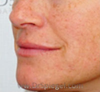 Lip Filler Before & After Gallery - Patient 157140952 - Image 3