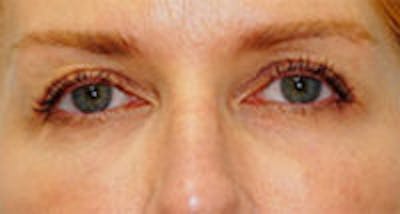 Tear Trough / Under Eye Fillers Before & After Gallery - Patient 157140951 - Image 2