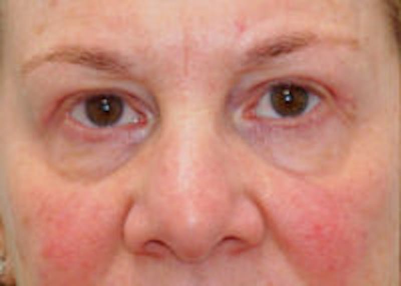 Tear Trough / Under Eye Fillers Before & After Gallery - Patient 157140953 - Image 1