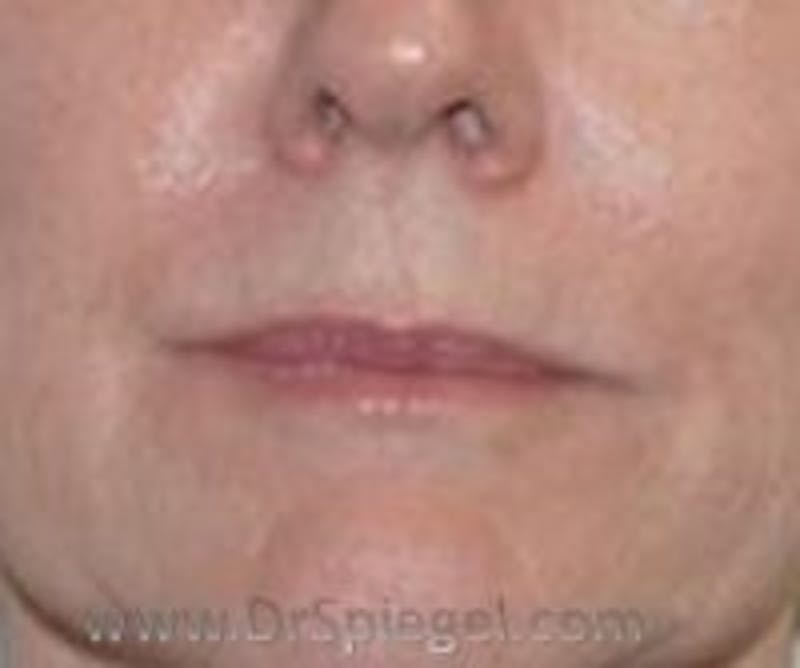 Lip Filler Before & After Gallery - Patient 157140956 - Image 2