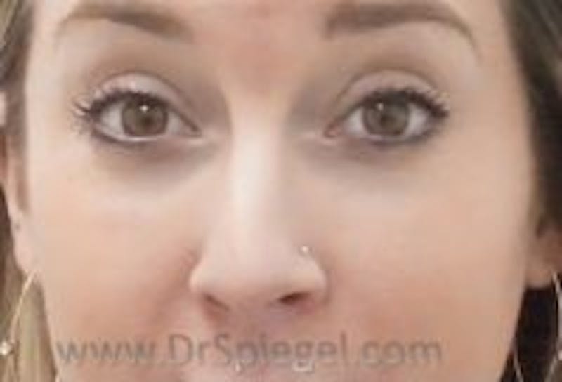 Tear Trough / Under Eye Fillers Before & After Gallery - Patient 157140957 - Image 1