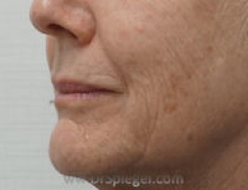 Lip Filler Before & After Gallery - Patient 157140956 - Image 4