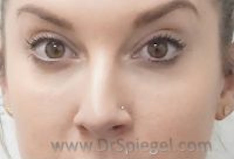 Tear Trough / Under Eye Fillers Before & After Gallery - Patient 157140957 - Image 2