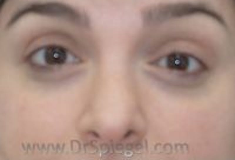 Tear Trough / Under Eye Fillers Before & After Gallery - Patient 157140959 - Image 1