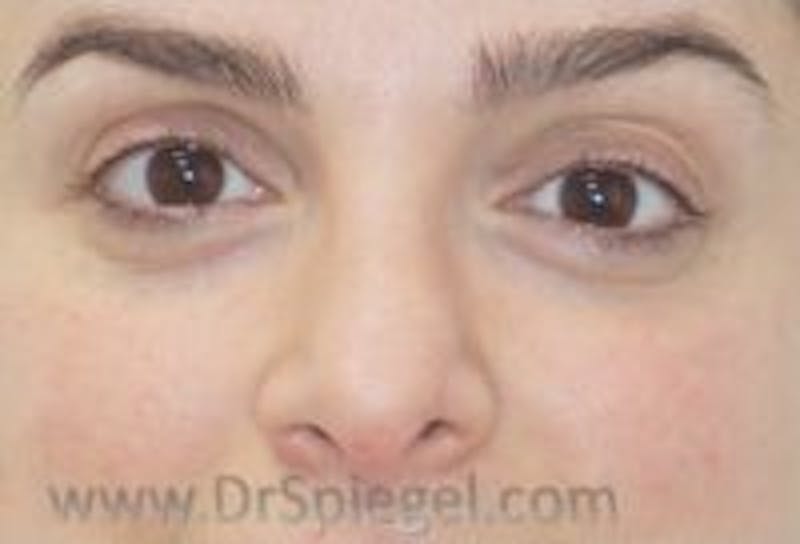 Tear Trough / Under Eye Fillers Before & After Gallery - Patient 157140959 - Image 2
