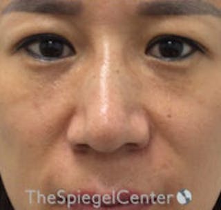 Non-Surgical Rhinoplasty / Nose Filler Before & After Gallery - Patient 157140964 - Image 2