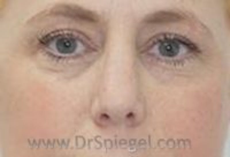 Tear Trough / Under Eye Fillers Before & After Gallery - Patient 157140962 - Image 2