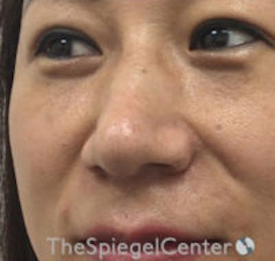 Non-Surgical Rhinoplasty / Nose Filler Before & After Gallery - Patient 157140964 - Image 3