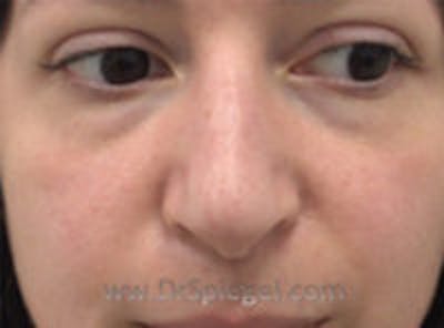 Non-Surgical Rhinoplasty / Nose Filler Before & After Gallery - Patient 157140969 - Image 1