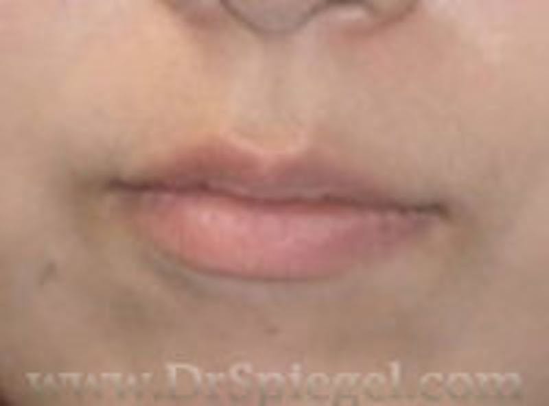 Lip Filler Before & After Gallery - Patient 157140967 - Image 1