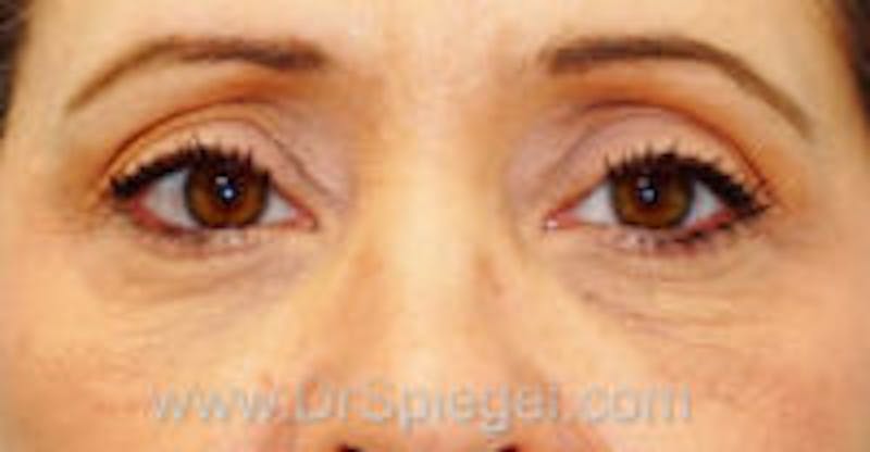 Tear Trough / Under Eye Fillers Before & After Gallery - Patient 157140968 - Image 2