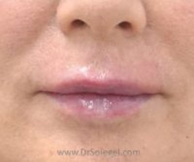 Lip Filler Before & After Gallery - Patient 157140970 - Image 2