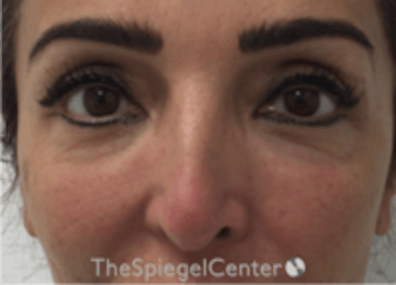 Non-Surgical Rhinoplasty / Nose Filler Before & After Gallery - Patient 157140971 - Image 1