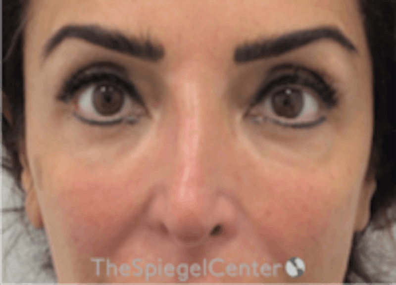 Non-Surgical Rhinoplasty / Nose Filler Before & After Gallery - Patient 157140971 - Image 2