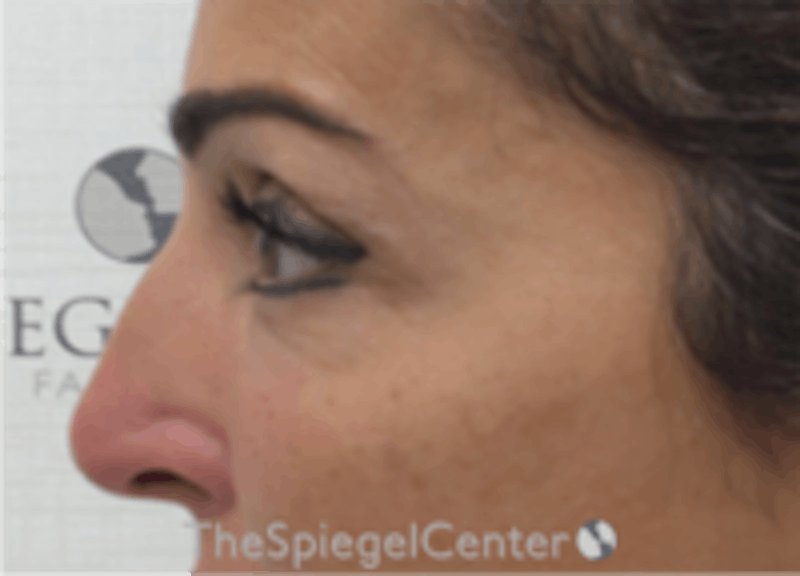 Non-Surgical Rhinoplasty / Nose Filler Before & After Gallery - Patient 157140971 - Image 3