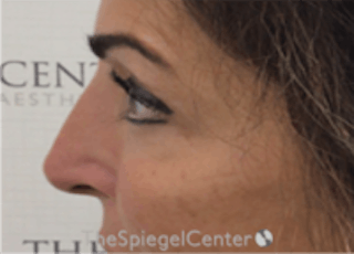 Non-Surgical Rhinoplasty / Nose Filler Before & After Gallery - Patient 157140971 - Image 4