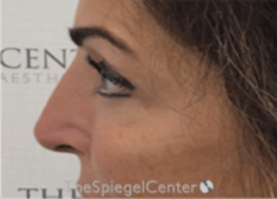 Non-Surgical Rhinoplasty / Nose Filler Before & After Gallery - Patient 157140971 - Image 4