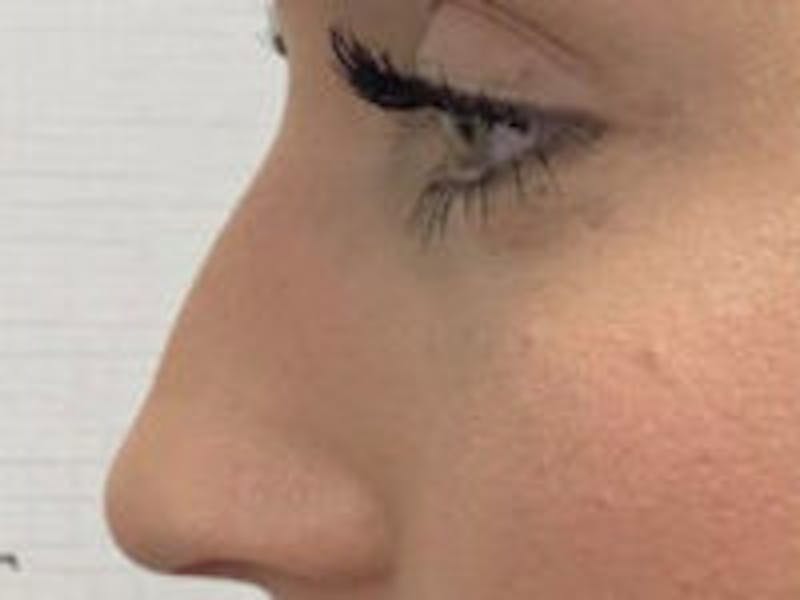 Non-Surgical Rhinoplasty / Nose Filler Before & After Gallery - Patient 157140972 - Image 3