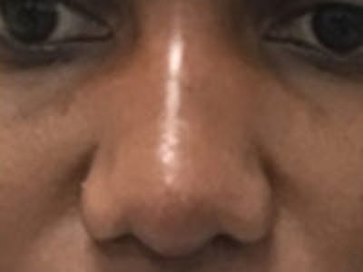Non-Surgical Rhinoplasty / Nose Filler Before & After Gallery - Patient 157140973 - Image 2