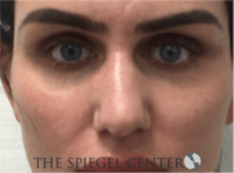 Non-Surgical Rhinoplasty / Nose Filler Before & After Gallery - Patient 157140974 - Image 1
