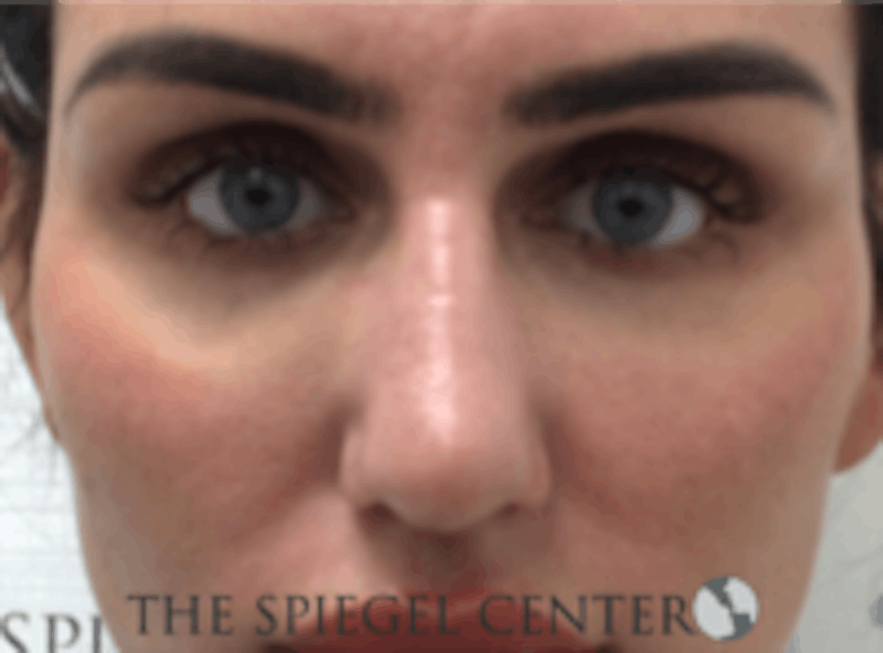 Non-Surgical Rhinoplasty / Nose Filler Before & After Gallery - Patient 157140974 - Image 2
