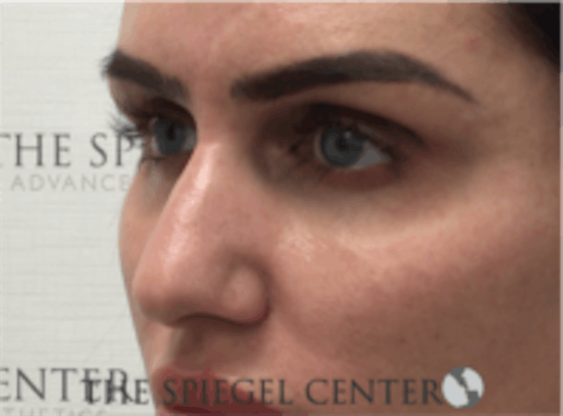 Non-Surgical Rhinoplasty / Nose Filler Before & After Gallery - Patient 157140974 - Image 3