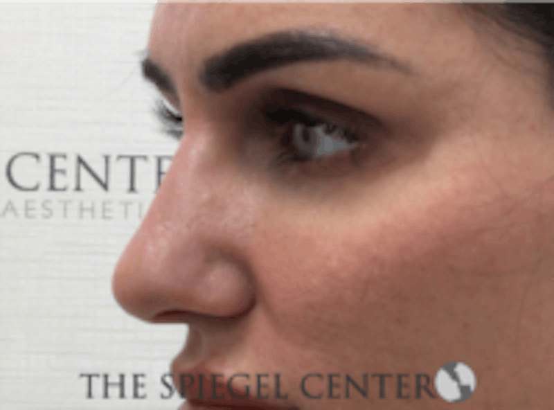 Non-Surgical Rhinoplasty / Nose Filler Before & After Gallery - Patient 157140974 - Image 4