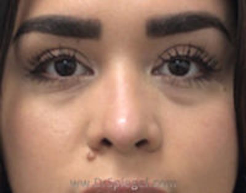 Non-Surgical Rhinoplasty / Nose Filler Before & After Gallery - Patient 157140975 - Image 1