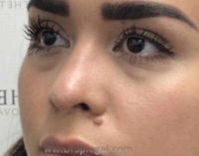 Non-Surgical Rhinoplasty / Nose Filler Before & After Gallery - Patient 157140975 - Image 3