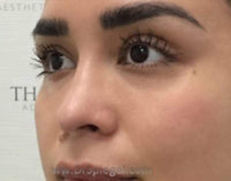 Non-Surgical Rhinoplasty / Nose Filler Before & After Gallery - Patient 157140975 - Image 4