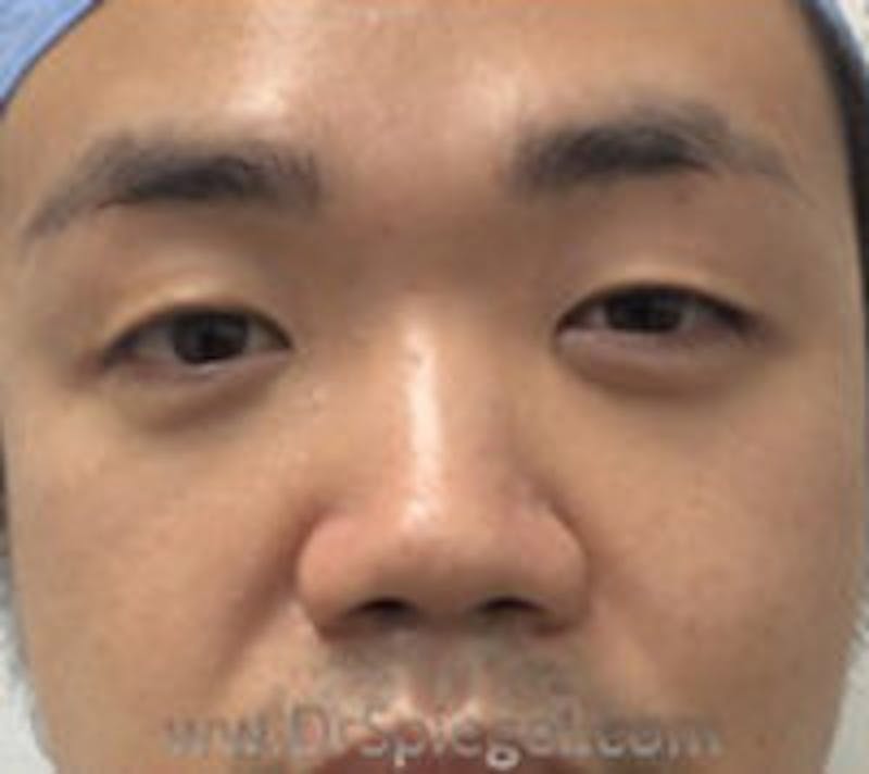 Non-Surgical Rhinoplasty / Nose Filler Before & After Gallery - Patient 157140977 - Image 1