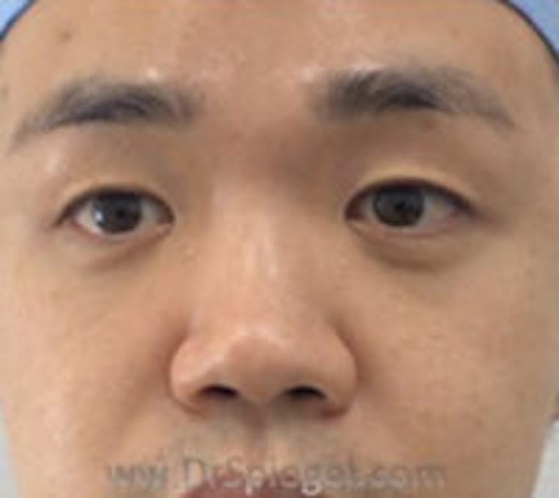 Non-Surgical Rhinoplasty / Nose Filler Before & After Gallery - Patient 157140977 - Image 2