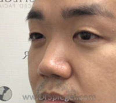 Non-Surgical Rhinoplasty / Nose Filler Before & After Gallery - Patient 157140977 - Image 3