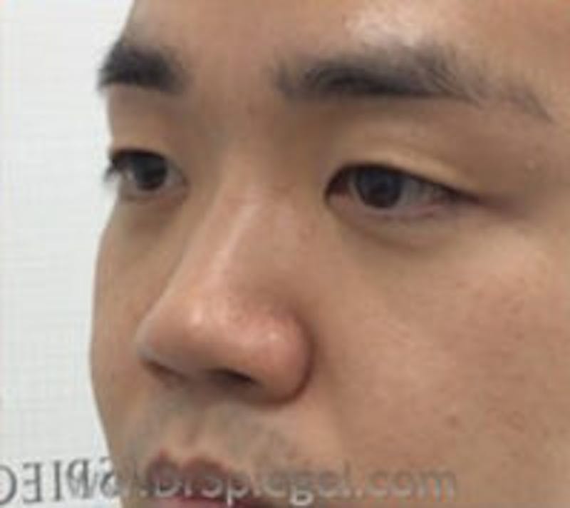 Non-Surgical Rhinoplasty / Nose Filler Before & After Gallery - Patient 157140977 - Image 4