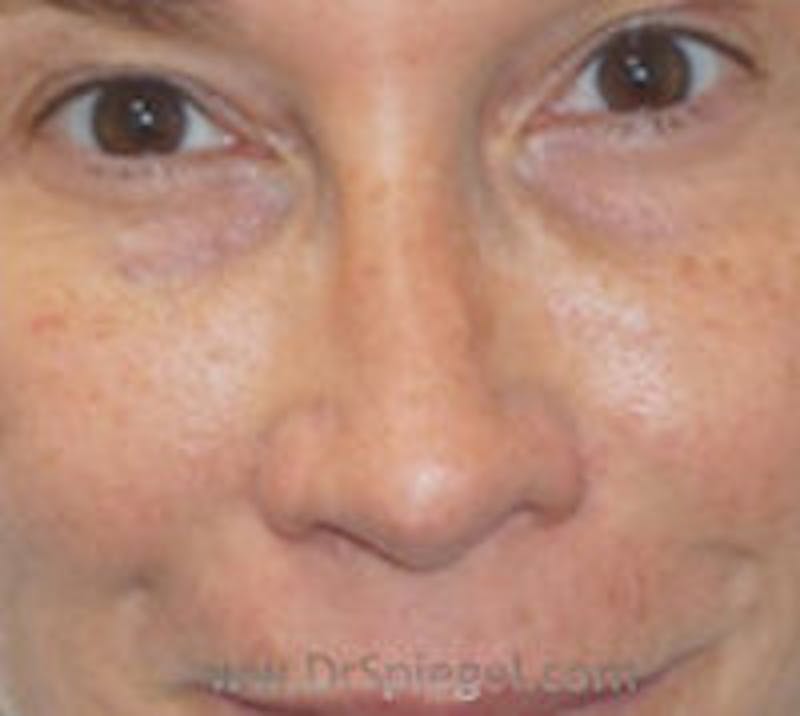 Non-Surgical Rhinoplasty / Nose Filler Before & After Gallery - Patient 157140978 - Image 2