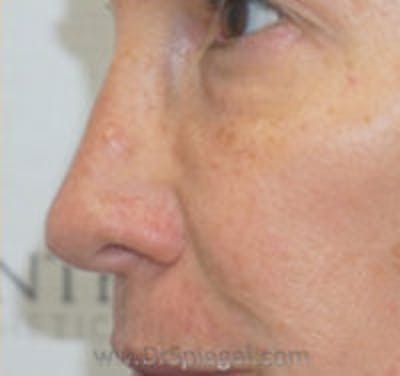 Non-Surgical Rhinoplasty / Nose Filler Before & After Gallery - Patient 157140978 - Image 3