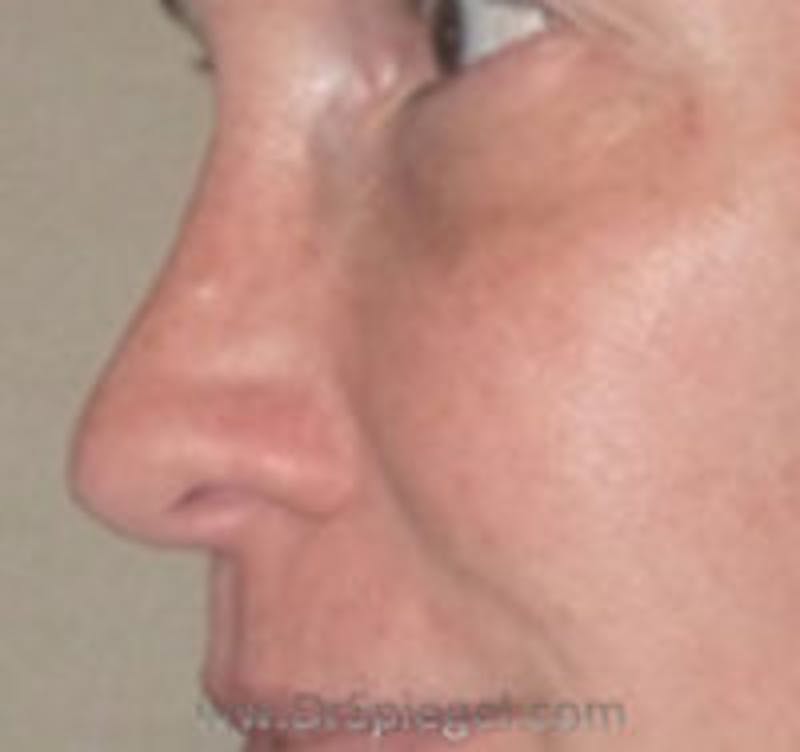 Non-Surgical Rhinoplasty / Nose Filler Before & After Gallery - Patient 157140978 - Image 4