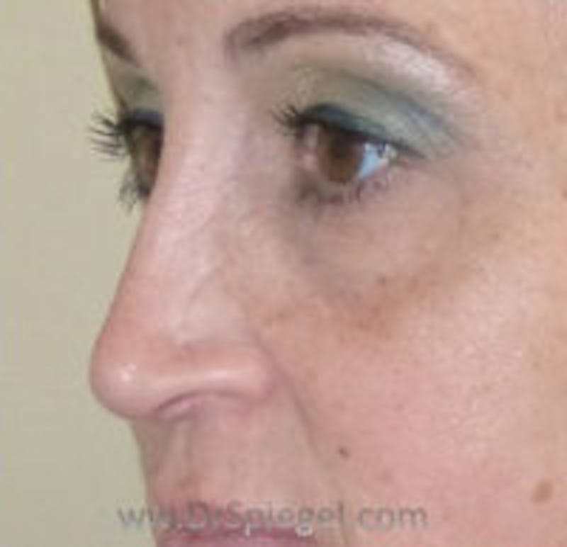Non-Surgical Rhinoplasty / Nose Filler Before & After Gallery - Patient 157140979 - Image 3