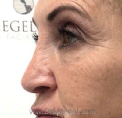 Non-Surgical Rhinoplasty / Nose Filler Before & After Gallery - Patient 157140979 - Image 4